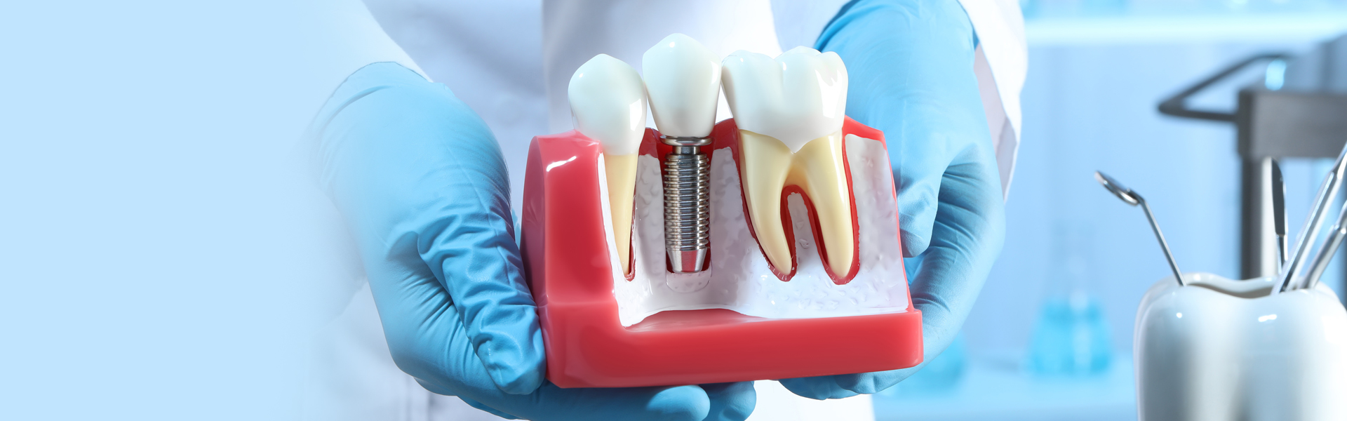 What Are the Alternatives to All-on-4 for Full Mouth Tooth Replacement?