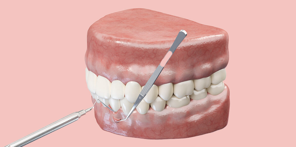 Gum Grafting guide