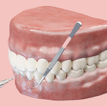 Gum Grafting guide