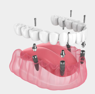 Dental Implant