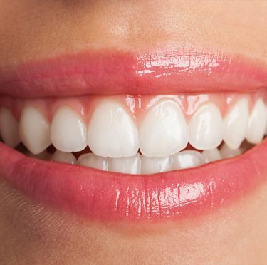 Top 5 Reasons Why You Should Consider Teeth Whitening